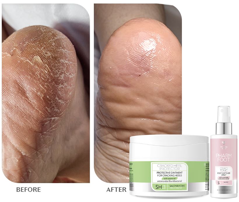 Pharm Foot - Ozone Cracked Heel Protector 75ML Fotkrem
